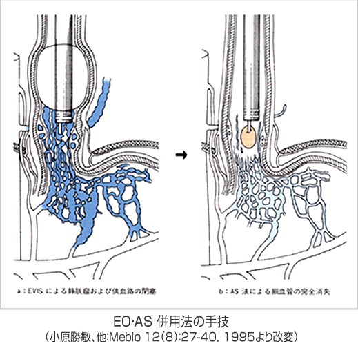 EO・AS 併用法の手技