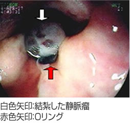 白色矢印：結紮した静脈瘤、赤色矢印：Oリング