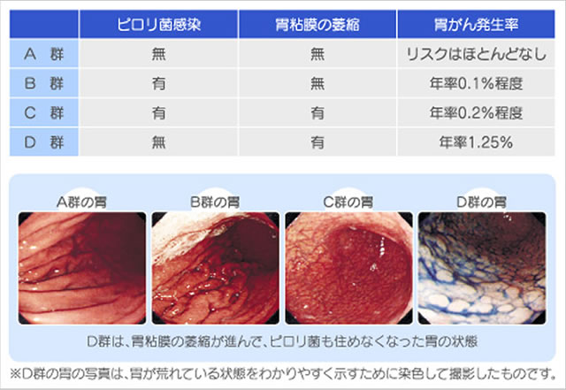 胃がんリスク検診