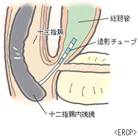 ERCP