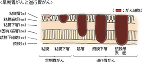 胃食道癌に対する内視鏡的切除適応