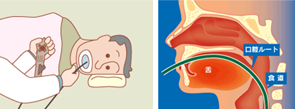 経口内視鏡