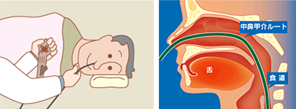 経鼻内視鏡