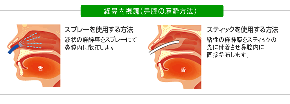 経鼻内視鏡（鼻腔の麻酔方法）