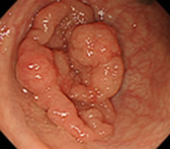 大腸内視鏡検査