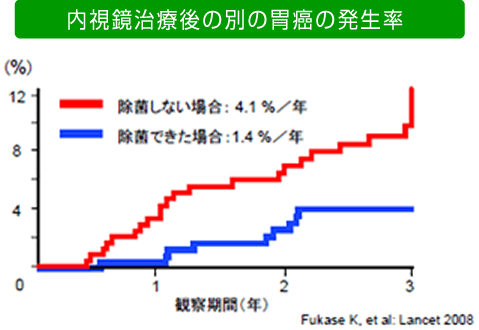 内視鏡治療後の別の胃癌の発生率